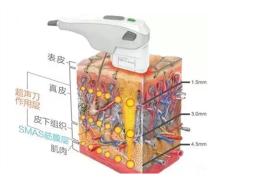 埋线和超声刀治疗那种好？