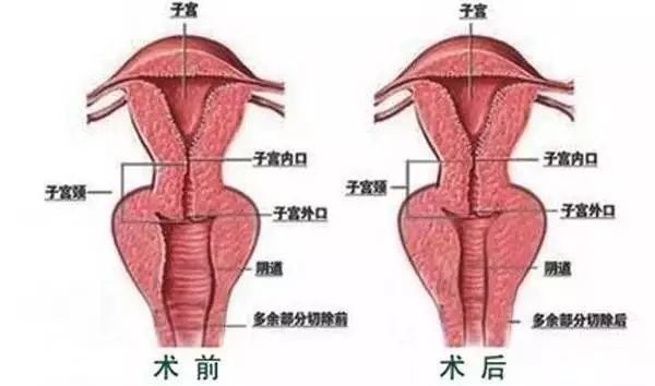 选择私密超声刀的理由
