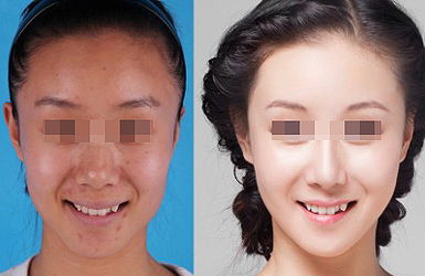 热拉提的治疗效果好不好？多久起效？